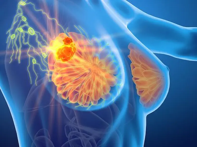 3 Ciri Kanker Payudara Stadium Awal